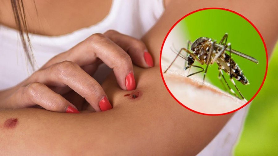 Pesë arsye pse jeni magnet për insektet