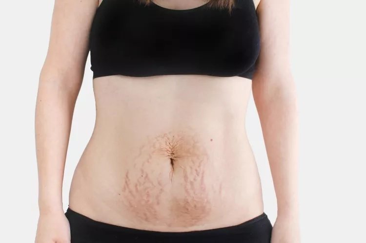 Çfarë duhet të dini për Diastasis Recti