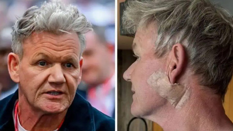 Gordon Ramsay kalon nëpër një operacion për kancerin e lëkurës: Mesazhi i tij për fansat