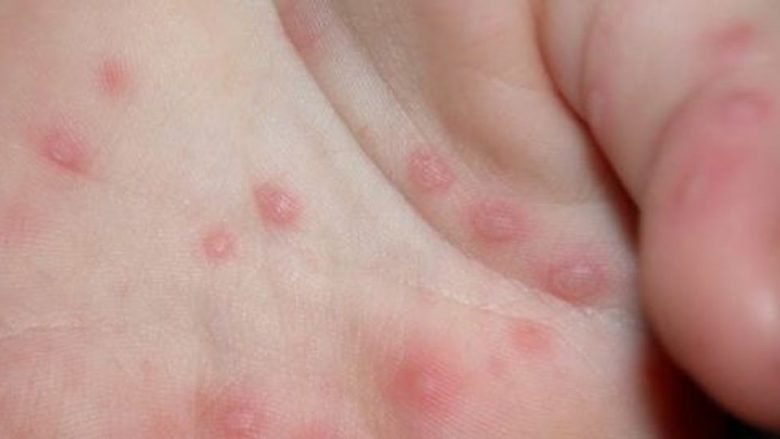 Një rast me “zgjebe” në Kumanovë, QSHP: Tre të dyshuarit e tjerë nuk janë infektuar