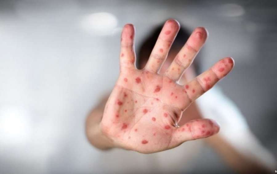 Fruthi alarmon Kosovën: 22 pacientë të shtrirë, mbi 100 raste të konfirmuara