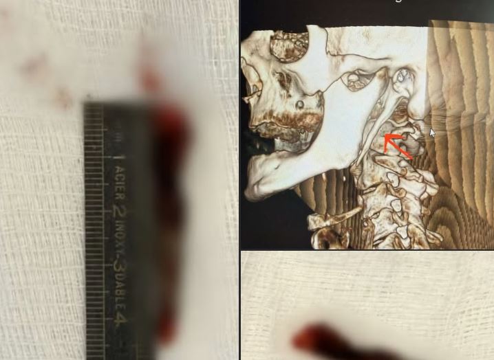 Për herë të parë në Kosovë kryhet me sukses operacioni për Sindromën Eagle