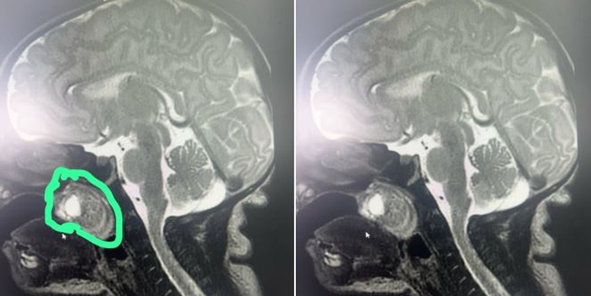 Realizohet me sukses një ndërhyrje e rrallë kirurgjikale  tumori largohet nga foshna e posalindur