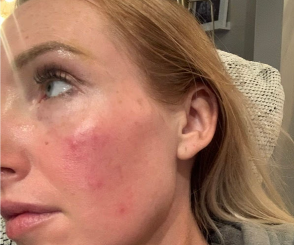 Mbeti pa frymë pasi bëri botox, gruaja kishte frikë se do të vdiste në gjumë