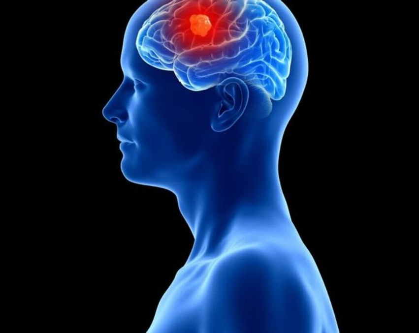 Implant i ri cerebral për zbulimin dhe luftimin e kancerit të trurit