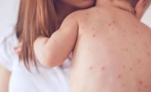 ​Alarmi i ekspertëve: Rënia e vaksinimit në Kosovë rrit rrezikun nga fruthi