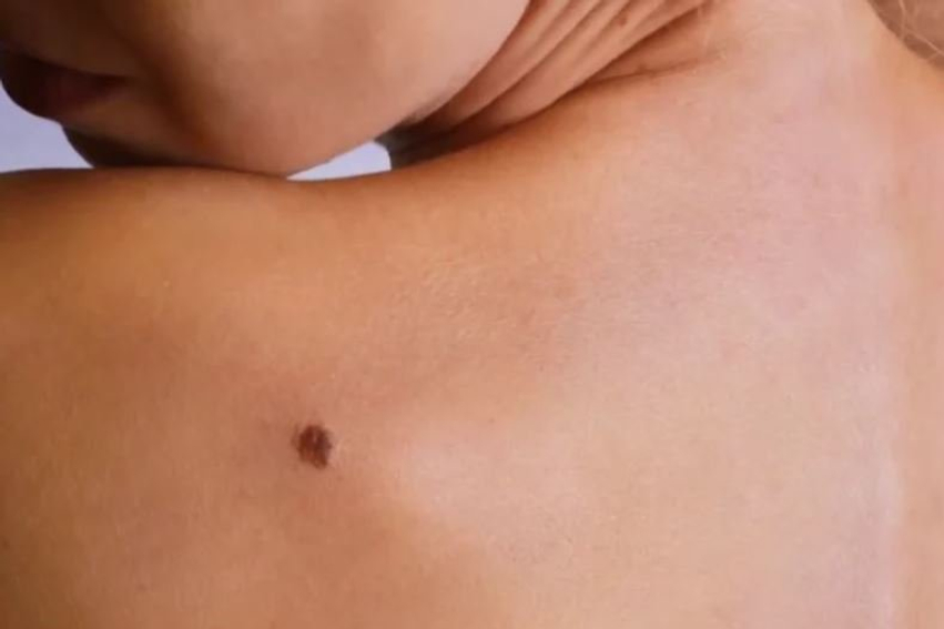 Mos neglizhoni nishanet  dermatologët paralajmërojnë  Ata sinjalizojnë   