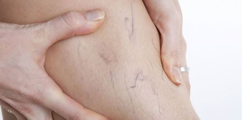 5 mite dhe të vërteta rreth sëmundjeve venoze