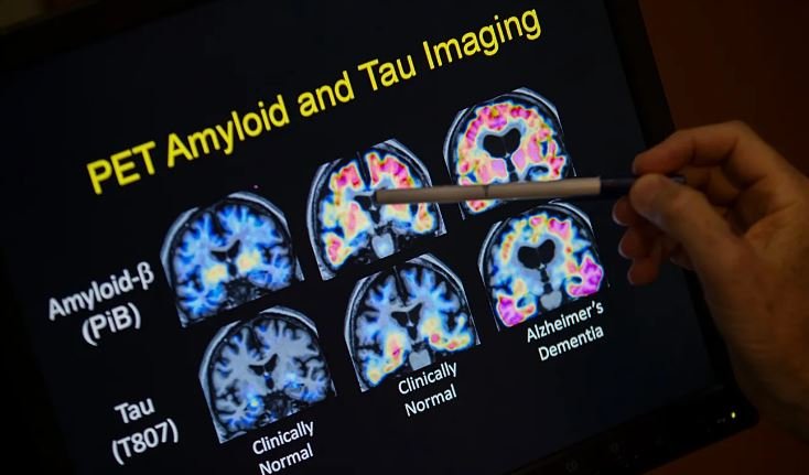 Zbulim i ri për Alzheimerin: Molekula eksperimentale rikthen kujtesën në testet te kafshët