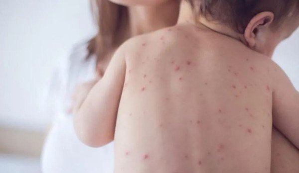 ​Në periudhën prill–tetor 203 raste me fruth, IKShPK: Vaksinimi, masa më efikase për shëndetin e fëmijëve